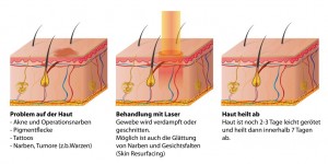 type-of-tattoo-removal