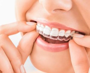 teeth retainers